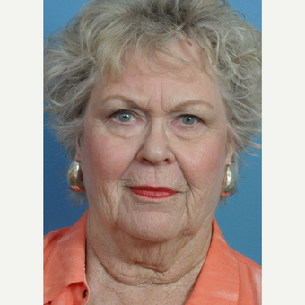 75 and up year old woman treated with Facelift before 3439350