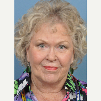 75 and up year old woman treated with Facelift after 3439350