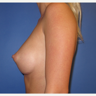 25-34 year old woman treated with Breast Implants (R. 295cc, L. 275cc) after 3544324