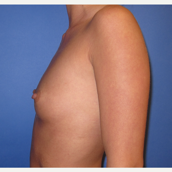 25-34 year old woman treated with Breast Implants (R. 295cc, L. 275cc) before 3544324