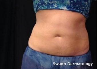 35-44 year old woman treated with CoolSculpting after 2246808