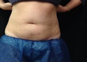 35-44 year old woman treated with CoolSculpting before 2246808
