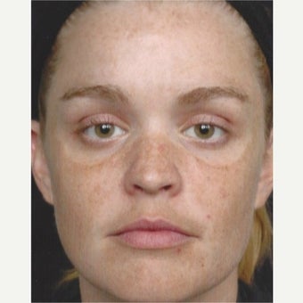 25-34 year old woman treated with Melasma Treatment with Obagi Nu Derm Skin Transformation before 2579566