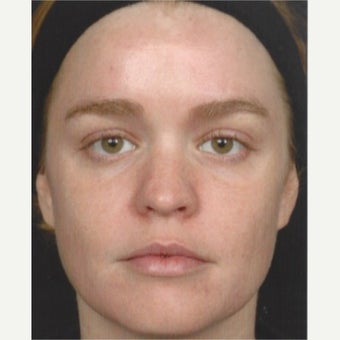 25-34 year old woman treated with Melasma Treatment with Obagi Nu Derm Skin Transformation after 2579566