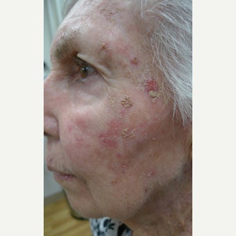 9 decades of sun damage removed with Fraxel. before 2482223
