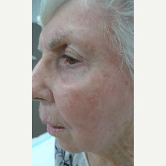 9 decades of sun damage removed with Fraxel. after 2482223