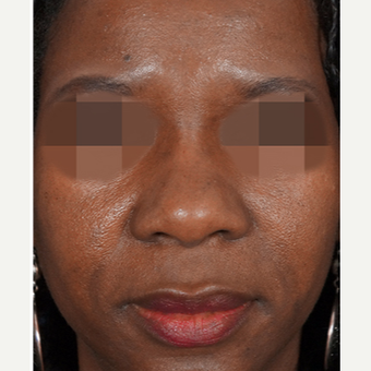 35-44 year old woman treated with Non Surgical Nose Job after 3244848