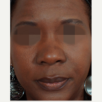 35-44 year old woman treated with Non Surgical Nose Job before 3244848