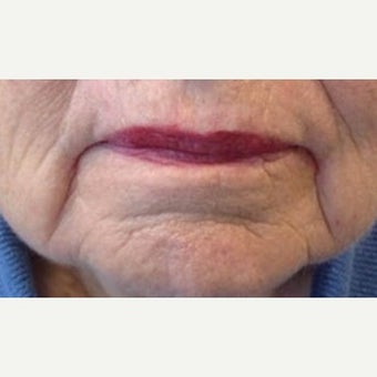 65-74 year old woman treated with Restylane Lyft before 2081935