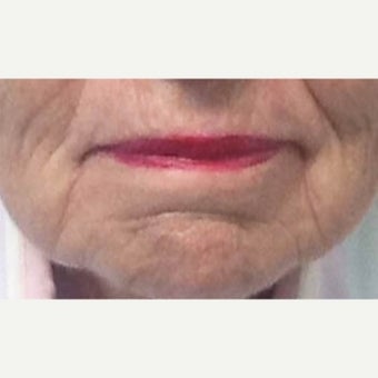 65-74 year old woman treated with Restylane Lyft after 2081935