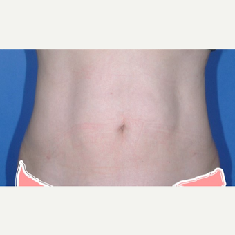 Liposuction after 3346196