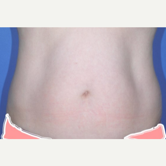 Liposuction before 3346196