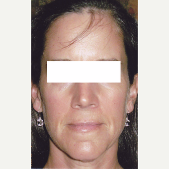 50 year old woman treated with Sculptra before 3055918