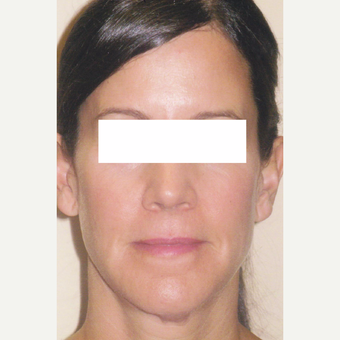 50 year old woman treated with Sculptra after 3055918