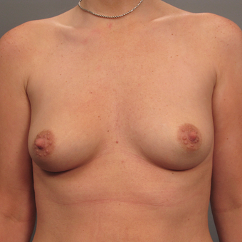 35-44 year old woman treated with Breast Augmentation with Strattice before 3293008