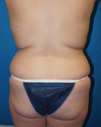 32 year old woman treated with Tummy Tuck 2488331