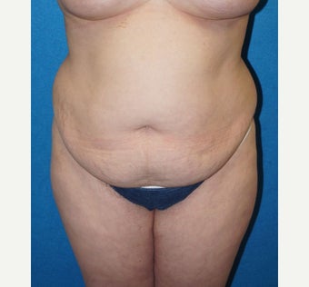 32 year old woman treated with Tummy Tuck before 2488331