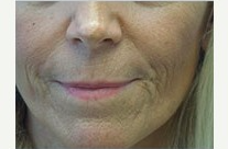 45-54 year old woman treated with Perlane before 2427514