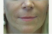 45-54 year old woman treated with Perlane after 2427514