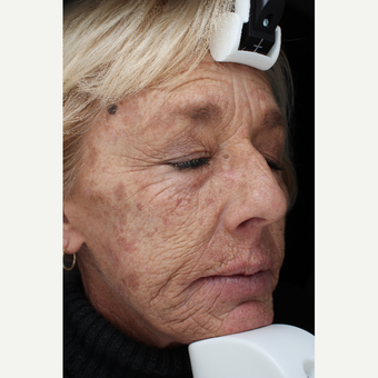 55-64 year old woman treated with Laser Resurfacing before 3710680