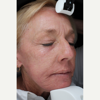 55-64 year old woman treated with Laser Resurfacing after 3710680
