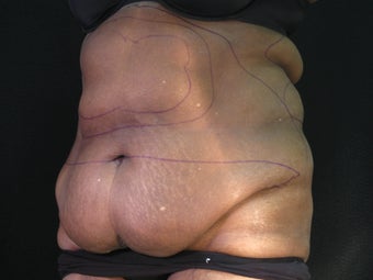 Liposuction abdominoplasty before 925155