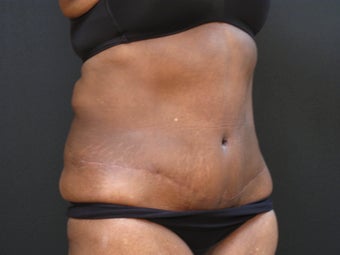 Liposuction abdominoplasty 925155