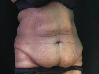 Liposuction abdominoplasty 925155