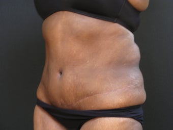 Liposuction abdominoplasty after 925155