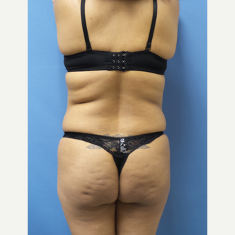 35-44 year old woman treated with Brazilian Butt Lift before 3696136