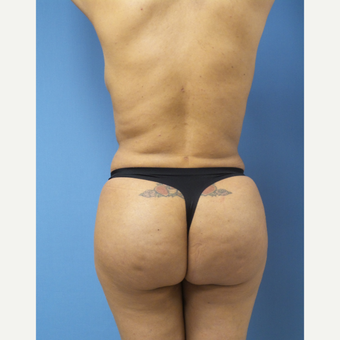 35-44 year old woman treated with Brazilian Butt Lift after 3696136