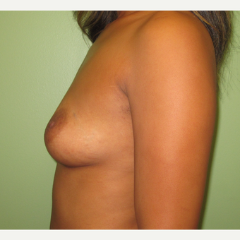 35-44 year old woman treated with Breast Augmentation before 3241942