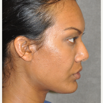 35-44 year old woman treated with Ultherapy after 3181765