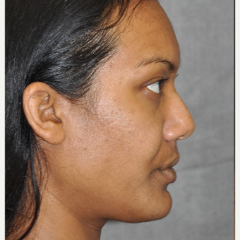 35-44 year old woman treated with Ultherapy before 3181765