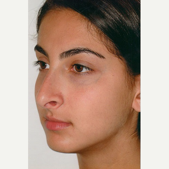 17 or under year old woman treated with Rhinoplasty before 3406273