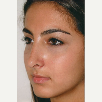 17 or under year old woman treated with Rhinoplasty after 3406273