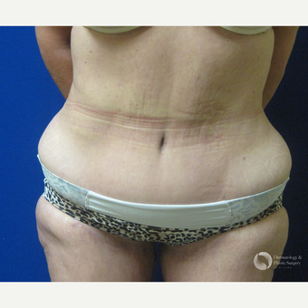 45-54 year old woman treated with Tummy Tuck after 3325304