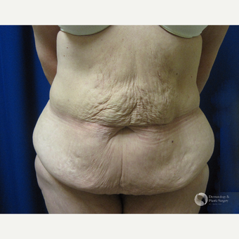 45-54 year old woman treated with Tummy Tuck before 3325304