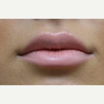18-24 year old woman treated with Juvederm after 3854692