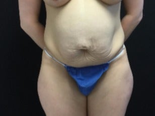 35-44 year old woman treated with Tummy Tuck before 3219217