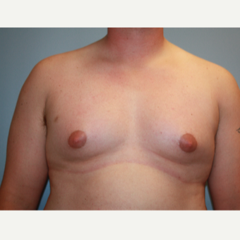 25-34 year old man treated with Male Breast Reduction before 3683182