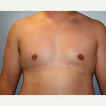 25-34 year old man treated with Male Breast Reduction after 3683182