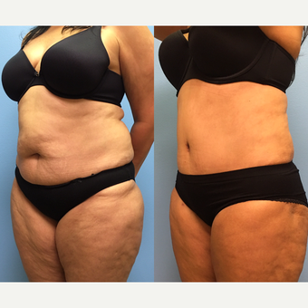 50 year-old woman treated with Tummy Tuck and Lipo 360 after 3495079