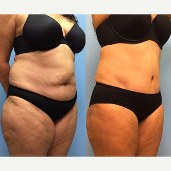 50 year-old woman treated with Tummy Tuck and Lipo 360 before 3495079