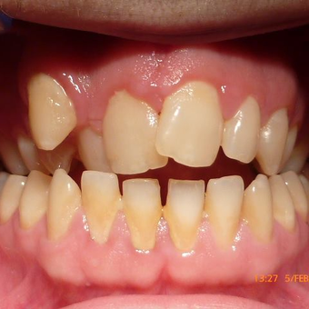 Smile Makeover Using Ceramic Braces before 3136513