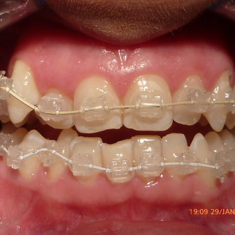 Smile Makeover Using Ceramic Braces after 3136513