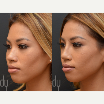 Non Surgical Nose Job before 3622621