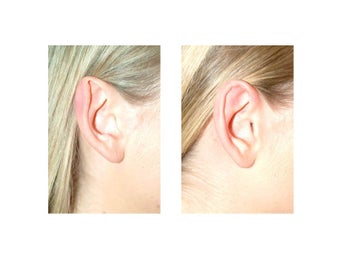 Otoplasty (Ear Surgery) before 1235687