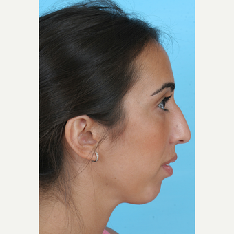 25-34 year old woman treated with Rhinoplasty before 3691151