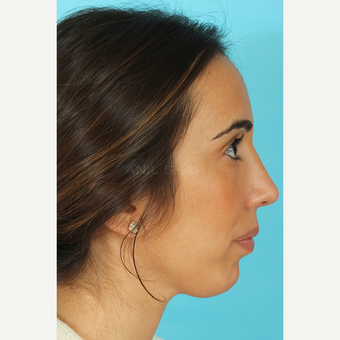 25-34 year old woman treated with Rhinoplasty after 3691151